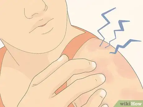 Image titled Recognize Hives (Rash) Step 1