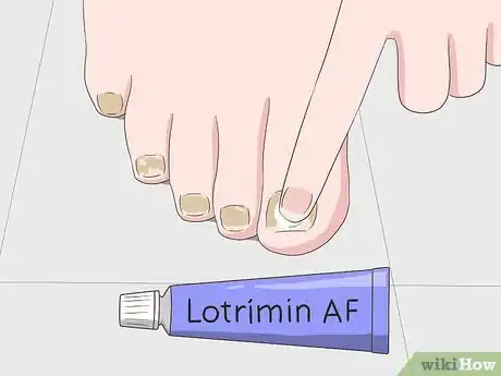 Image titled Treat a Black Toenail Step 10