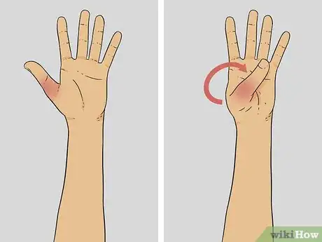Image titled Diagnose a Broken Thumb Step 3