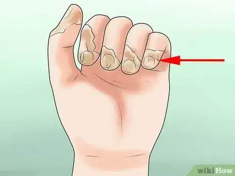 Image titled Prevent Frostbite Step 37