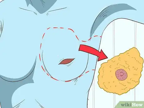 Image titled Treat Breast and Extramammary Paget's Disease Step 1
