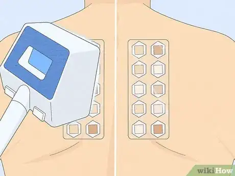 Image titled Patch Test Skin Step 4