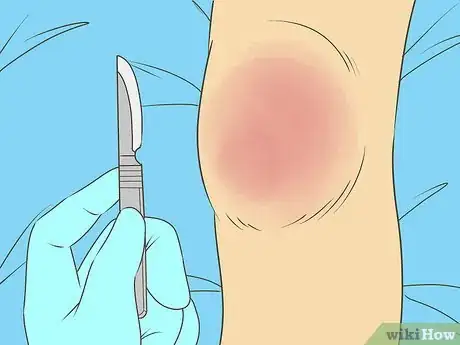Image titled Diagnose Bursitis Step 17