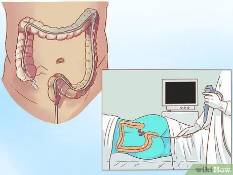 Image titled Live With Inflammatory Bowel Disease Step 6