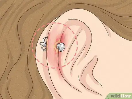 Image titled What Can You Use to Clean an Ear Piercing Step 6