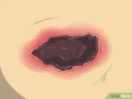Image titled Know if a Wound Is Healing Step 7