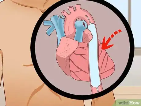 Image titled Treat Obstructive Shock Step 10