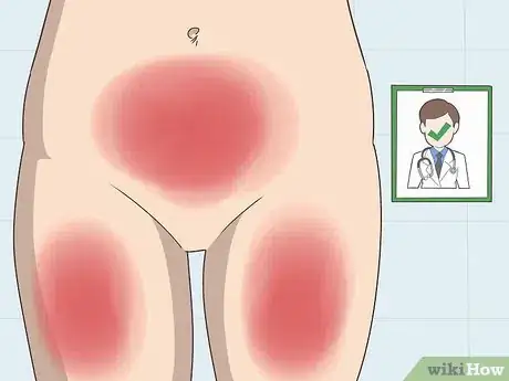 Image titled Diagnose Bladder Cancer Step 2
