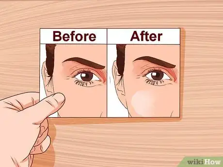 Image titled Get Collagen Induction Therapy Step 4