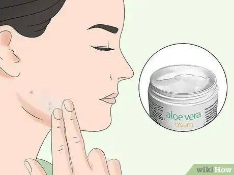 Image titled Use Herbs to Treat Acne Step 3