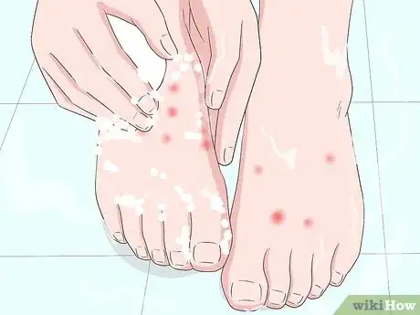 Image titled Stop Gnat Bites from Itching Step 6