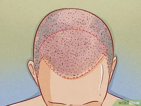 Image titled Deal with Bald Spots Step 6