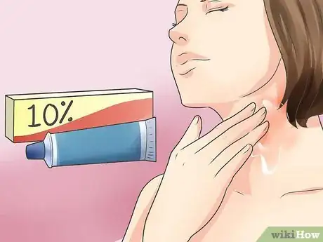 Image titled Recognize Scabies Rash Step 10