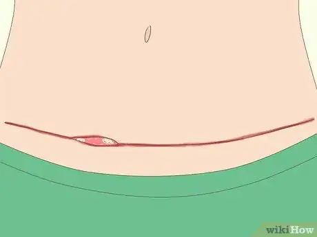 Image titled Have Plastic Surgery Step 7