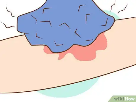 Image titled Get Rid of Poison Ivy Step 12