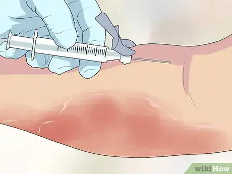 Image titled Diagnose Erythrodermic Psoriasis Step 2