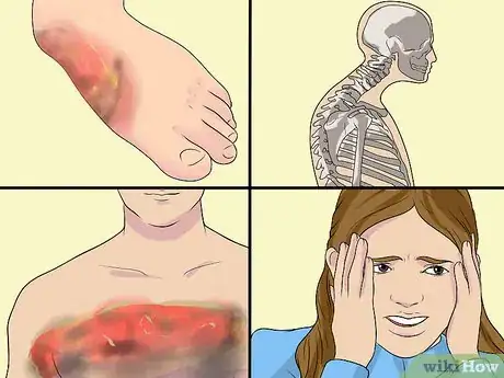 Image titled Diagnose Erythrodermic Psoriasis Step 5