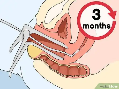 Image titled Have Essure Sterilization Reversed Step 4
