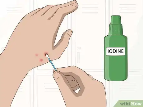 Image titled Stop Gnat Bites from Itching Step 7