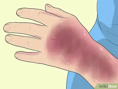 Image titled Diagnose Erythrodermic Psoriasis Step 6