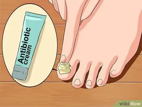 Image titled Remove a Dead Toenail Step 15