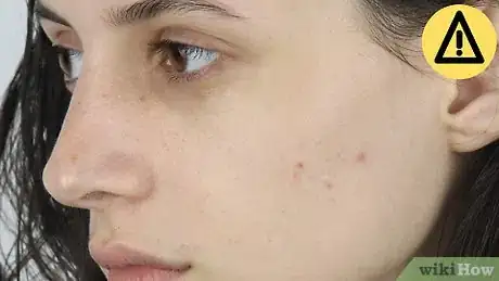 Image titled Clear Your Skin Overnight Step 6