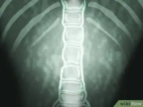 Image titled Deal With Scoliosis Surgery Step 6