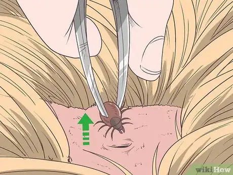 Image titled Check for Ticks Step 9