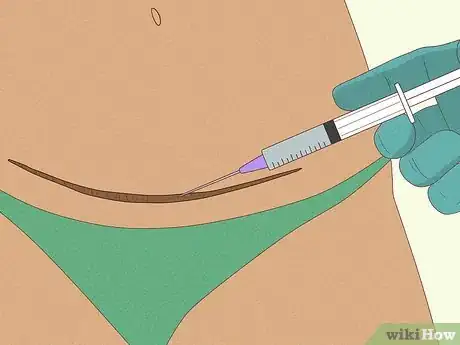 Image titled Lighten a C‐Section Scar Step 8