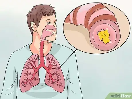 Image titled Recognize Bronchitis Symptoms Step 1