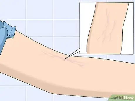 Image titled Inject Into a Vein Step 6