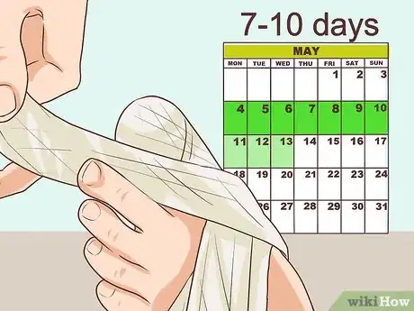 Image titled Treat a Torn Toenail Step 6