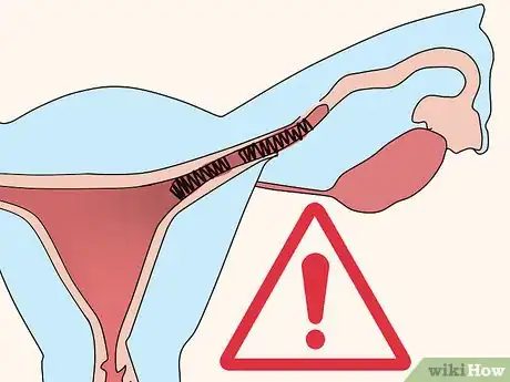 Image titled Have Essure Sterilization Reversed Step 9