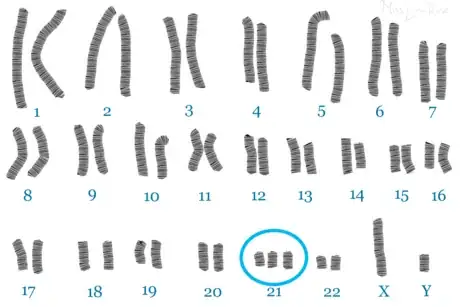Image titled Down Syndrome Karyotype.png