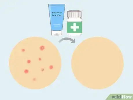 Image titled Treat Adult Acne Step 21