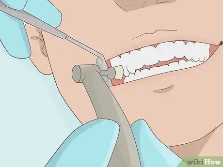 Image titled Prevent a Root Canal Step 5