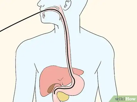 Image titled Diagnose Esophageal Diverticulum Step 9