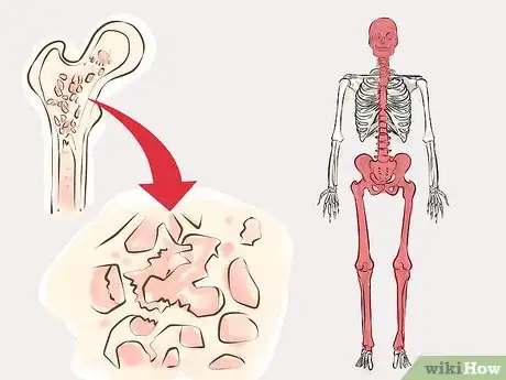Image titled Treat Paget's Disease Step 8