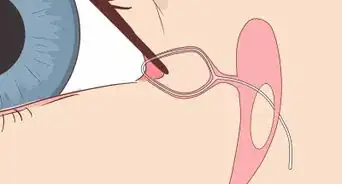 Clear a Blocked Tear Duct