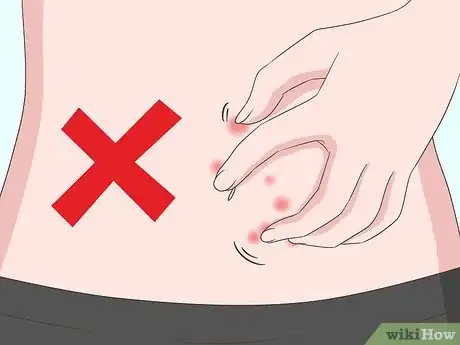 Image titled Stop Gnat Bites from Itching Step 8