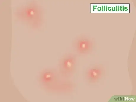 Image titled Get Rid of Fordyce Spots Step 12