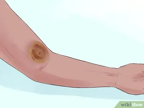 Image titled Recover from an Angioplasty Step 8