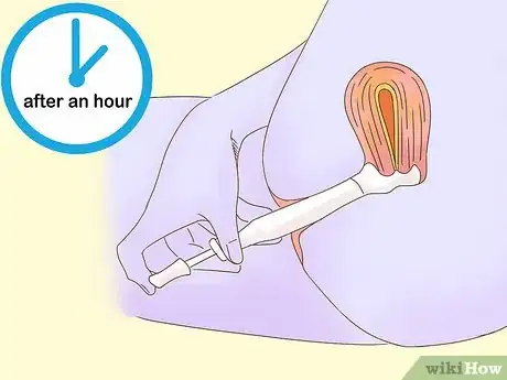 Image titled Use Spermicides Step 6