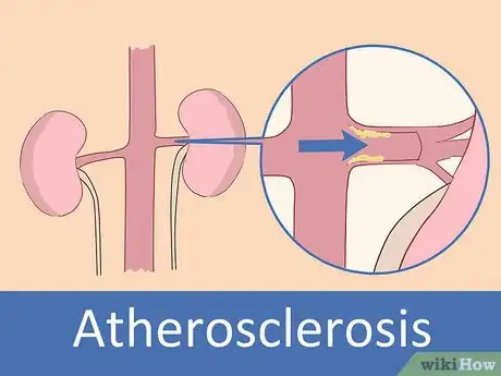 Image titled Prevent Renal Artery Stenosis Step 12