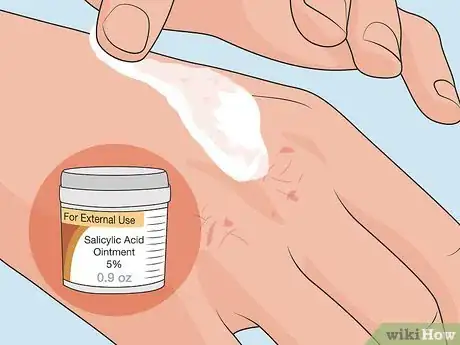Image titled Control Psoriasis Step 04