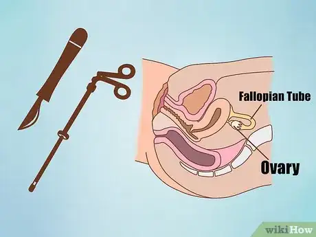 Image titled Get Fertility Treatments Step 7