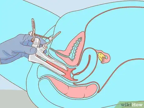 Image titled Test for HPV Step 5