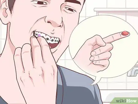 Image titled Cope With Braces As a Teenager Step 10