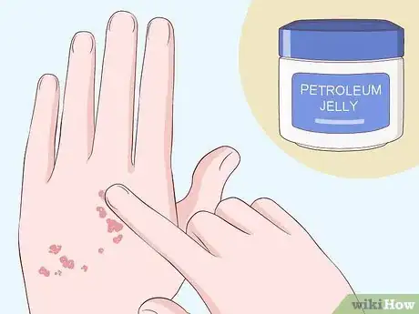 Image titled Heal Scabies Scars Step 16