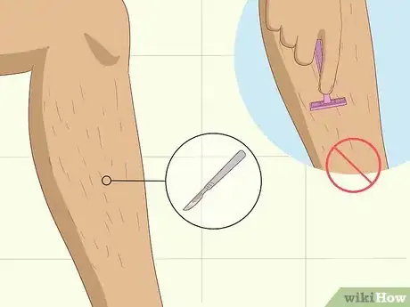 Image titled Prevent Surgical Site Infections Step 5
